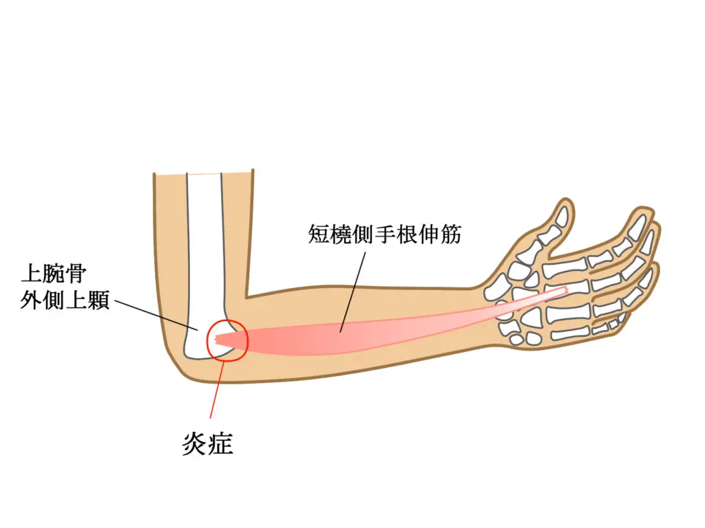 物を持つと肘が痛い！「テニス肘」 - あおぞら整骨院・鍼灸院