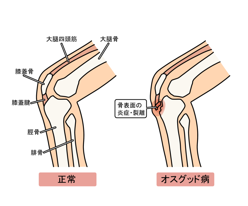 10歳～15歳に多い膝の痛み「オスグッド・シュラッター病」その対処
