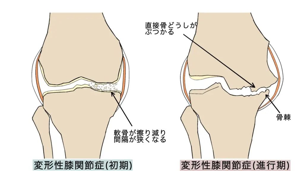 変形性膝関節症の対処法とは - あおぞら整骨院・鍼灸院