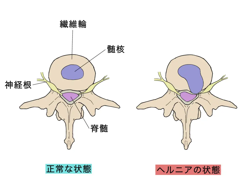 腕や背中の痛み、しびれ「頸椎椎間板ヘルニア」になってしまったら
