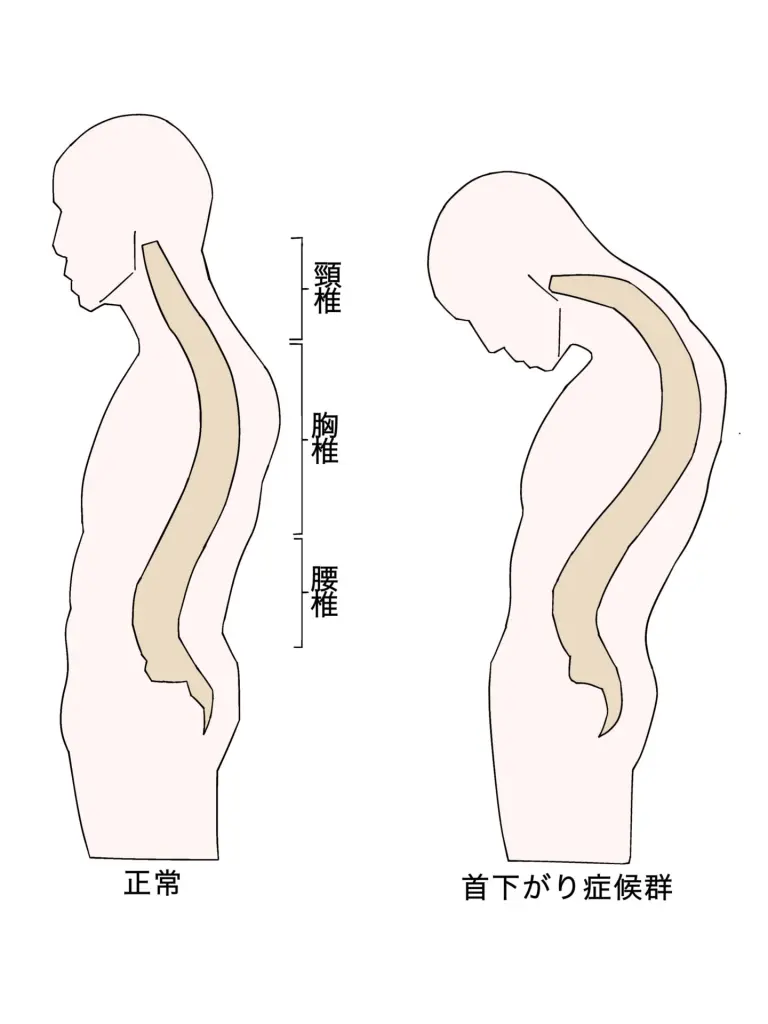 首 下がり 症候群 写真